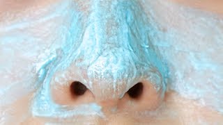 HOW TO Get Rid Of Blackheads INSTANTLY [upl. by Mcquillin335]