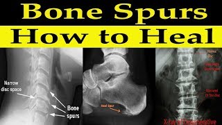 How to Heal Bone Spurs Naturally  Dr Alan Mandell DC [upl. by Enimzzaj]