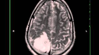 Oligodendroglioma [upl. by Page577]