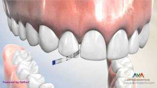 Interproximal Reduction or IPR  Polishing Strip [upl. by Lust]