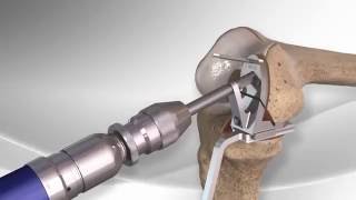 Partial Knee Replacement with the Arthrex® iBalance® UKA [upl. by Ivel]