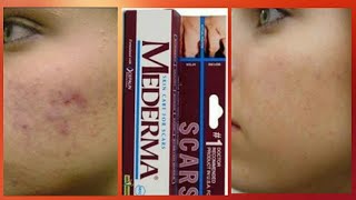 Mederma skin cream review  Scar ointment gel Mederma [upl. by Eanom552]