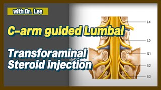 lumbar L5 transforaminal L5S1 facet joint injection C arm lecture amp clinical case [upl. by Raynata]