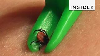 How To Remove Ticks [upl. by Lathan]