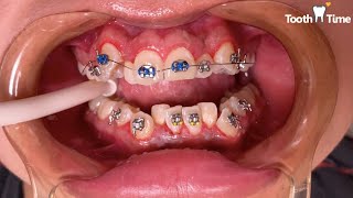 Braces On  Molar Bands  Tooth Time Family Dentistry [upl. by Ydnamron]