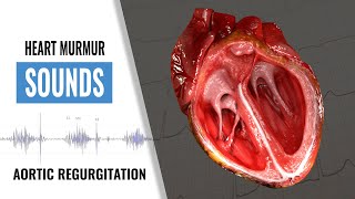 Aortic Regurgitation Heart Sound  Heart Murmur  Christina NP [upl. by Aiket407]