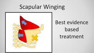 Scapular Winging Causes and Treatment [upl. by Anivek]