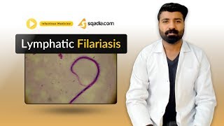 Lymphatic Filariasis  Medicine Lectures  Medical Student  VLearning  sqadiacom [upl. by Enomys7]