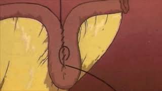 Continent Ileostomy quotKock pouchquot video [upl. by Podvin738]