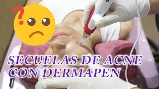 ELIMINAR CICATRICES DE ACNE CON DERMAPEN  Como es una sesión de Dermapen Microneedling [upl. by Cotter]