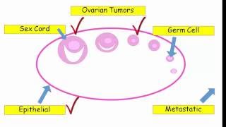 12DaysinMarch Ovarian Tumors for USMLE Step One [upl. by Aihtnamas588]