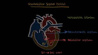 Ventriküler Septal Defekt Fen Bilimleri Sağlık ve Tıp [upl. by Sankaran412]