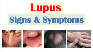 Lupus Signs amp Symptoms amp Why They Occur  Skin Joints Organ Systems [upl. by Yonita665]