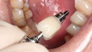 Full Contour Zirconia Implant Crown Insert [upl. by Nnaed]