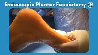 Endoscopic Plantar Fasciotomy Surgery [upl. by Erdnaet743]