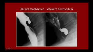 What is a Swallowing Disorder Dysphagia Overview [upl. by Brezin]