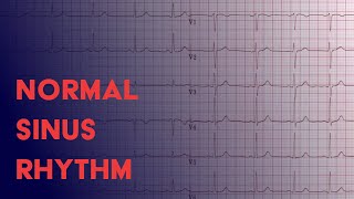 Normal Sinus Rhythm  EKG ECG Interpretation [upl. by Emmie]