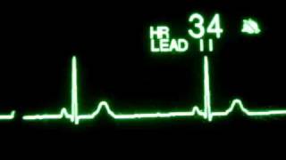 Sinus Bradycardia [upl. by Nyvek]