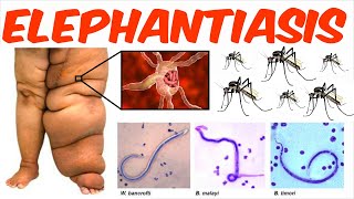 Lymphatic Filariasis  Elephantiasis [upl. by Danzig]