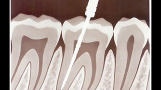 Recomendaciones y complicaciones tras una endodoncia [upl. by Abehs]