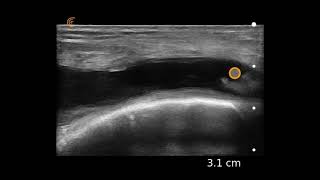 Knee Functional Tests  Clinical Physio [upl. by Kinsley648]