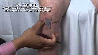 Knee Injection  Anterior Approach [upl. by Ardnasil]