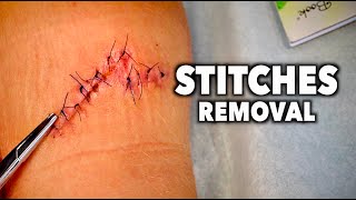 REMOVING 13 STITCHES From a Huge Leg Wound  Dr Paul [upl. by Wichern]