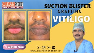 Vitiligo Treatment Options [upl. by Gizela]