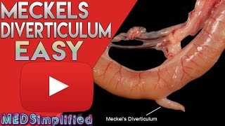 Meckels Diverticulum Made Easy [upl. by Attena]