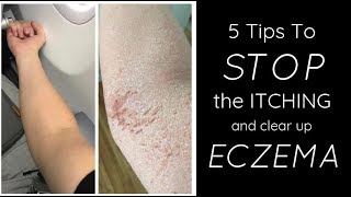 HEALING ECZEMA  5 Things I Do Each Day To STOP THE ITCH [upl. by Eanaj]