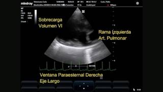 Persistencia del conducto arterioso [upl. by Sev]