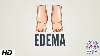 The Eight Causes Of Edema  Dr Berg [upl. by Norek]