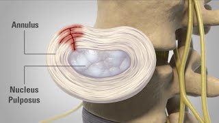 Patient Animation  Lumbar Degenerative Disc Disease [upl. by Arykat]