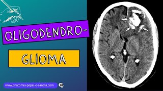 Oligodendroglioma [upl. by Leyes]