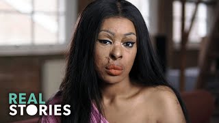 ACID ATTACK My Story Crime Documentary  Real Stories [upl. by Nayllij]