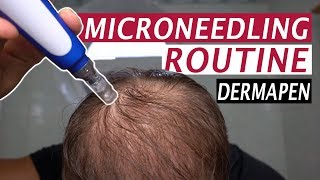 My Microneedling Routine and Derma Rolling for Hair Loss [upl. by Adeuga]