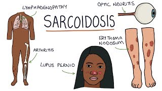 Understanding Sarcoidosis A Visual Guide for Students [upl. by Rednasyl]