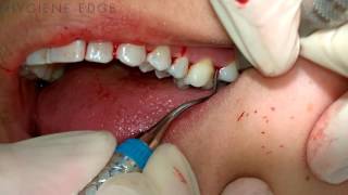 Gracey Instrumentation During Periodontal Therapy [upl. by Hsiri]