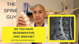 Lumbar Degenerative Disc Disease Part 1 Symptoms and Imaging [upl. by Atsirk]