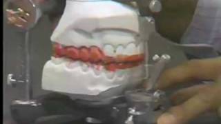 Occlusal Adjustment  Centric Relation [upl. by Uela]