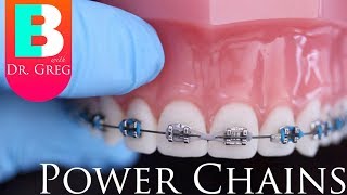 BRACES EXPLAINED Power Chains [upl. by Doble990]