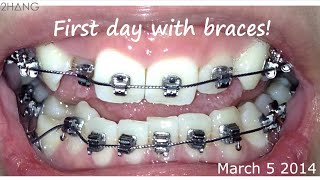 BRACES BEFORE AND AFTER TIME LAPSE [upl. by Eslehc]