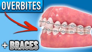 How Do BRACES FIX Overbites  Overbite Before and After Braces  Premier Orthodontics [upl. by Gotcher]