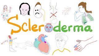 Scleroderma Systemic Sclerosis  Signs Symptoms Pathophysiology  Rheumatology [upl. by Adneram]