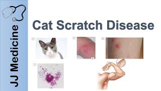 Cat Scratch Disease  Causes Symptoms and Treatment [upl. by Adhern]