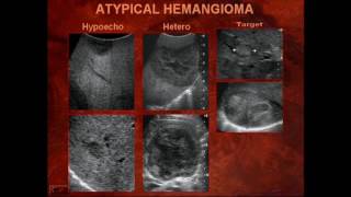 Sonography of Liver Masses [upl. by Nibaj377]