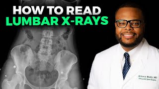 How to Read a Lumbar XRay [upl. by Tybie]