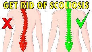 How to fix scoliosis naturally in 4 minutes a day [upl. by Marvel]