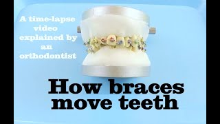 How braces move teeth timelapse  Braces Explained [upl. by Yllrebmik]