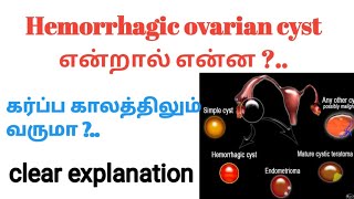 Dr G Buvaneswari  Fertility Specialist  PCOS In tamil  நீர்கட்டிகள் அறிகுறிகள் மற்றும் காரணங்கள் [upl. by Schlesinger]